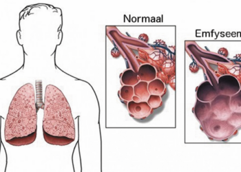 “Met Chiesi naar een rookvrije toekomst: Actie tegen COPD”